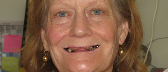 patient before dental implant treatment at Madison Dentistry