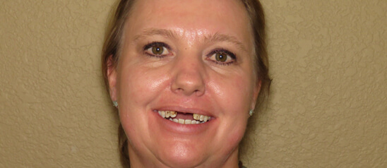 woman with missing teeth