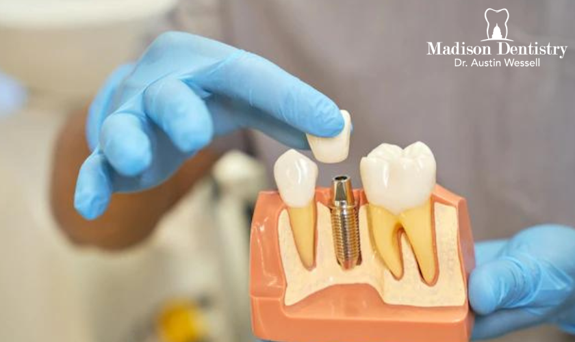 What Can Happen After Dental Implant Surgery?