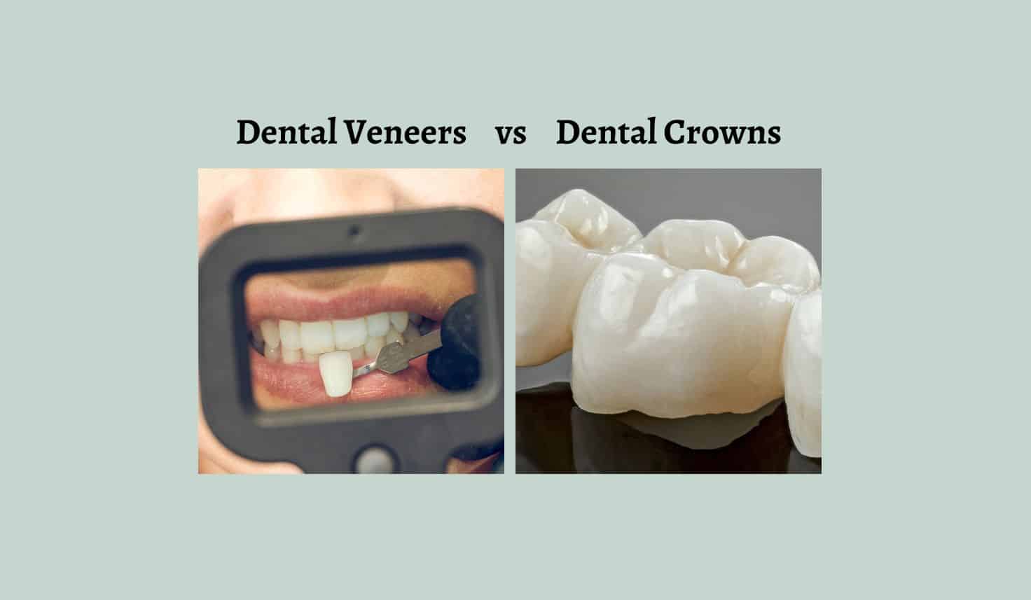 Dental Veneers