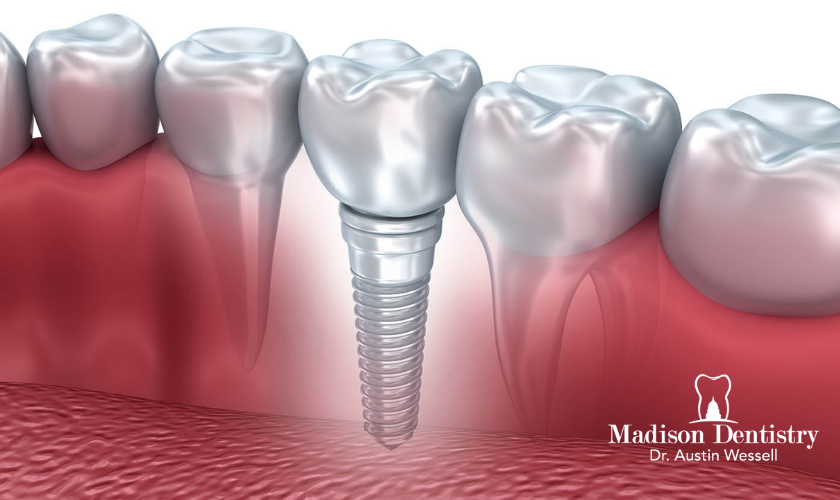 why people prefer dental implants