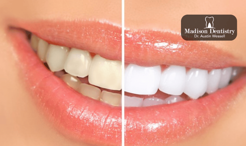 Professional Teeth Whitening