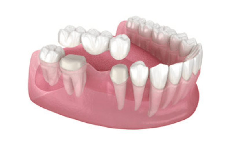 Dental Bridge Aftercare Tips