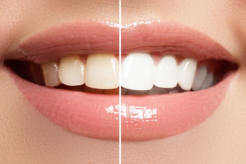 Teeth Whitening in Madison at Madison Dentistry