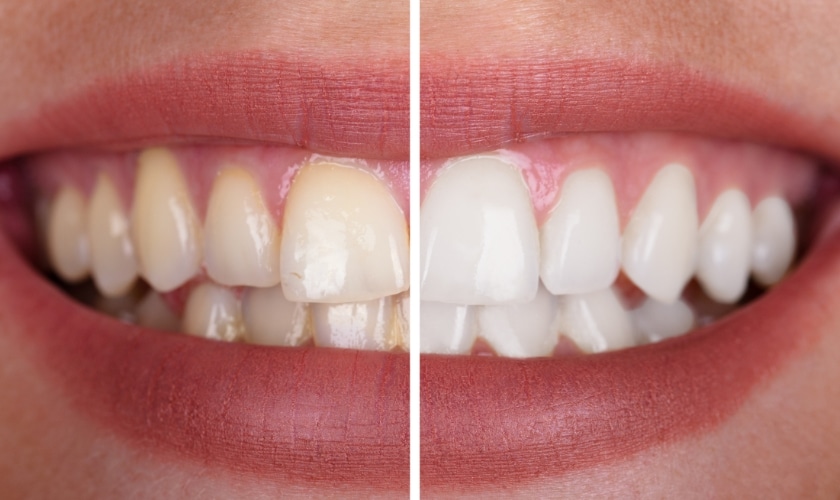 Teeth Whitening Methods in Madison