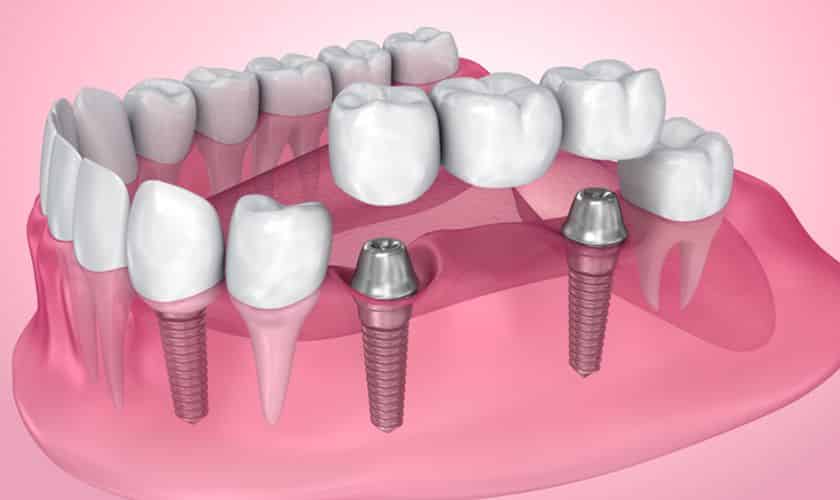 Number of Dental Implants - Madison Dentistry