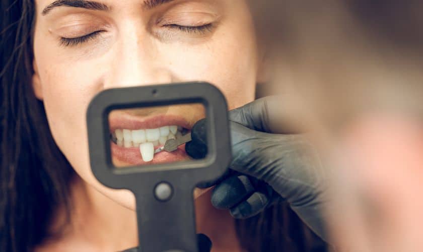 Step-by-Step Process of Getting Dental Veneers - Madison Dentistry